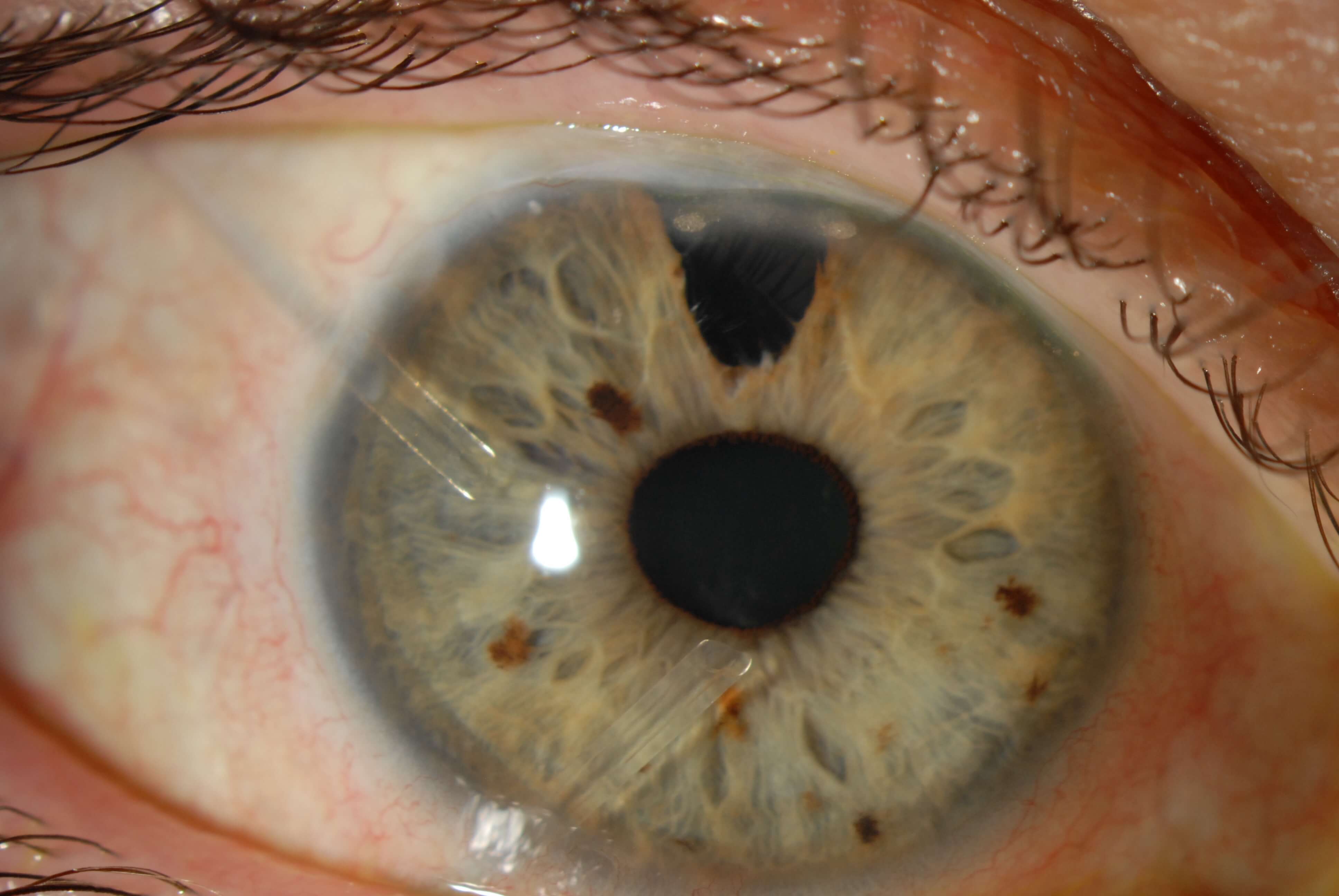 Ojo con 2 implantes de drenaje